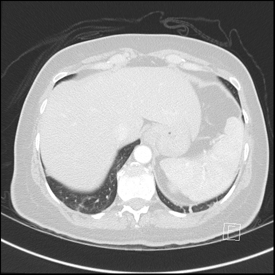 Breast metastases from renal cell cancer (Radiopaedia 79220-92225 Axial lung window 75).jpg