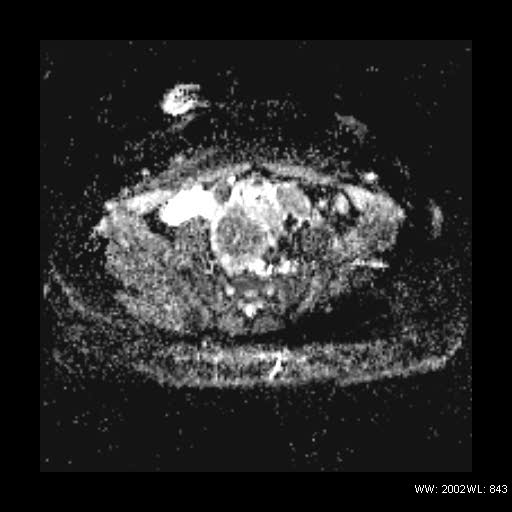 File:Broad ligament fibroid (Radiopaedia 49135-54241 Axial ADC 12).jpg