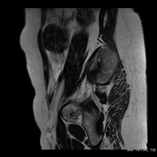 File:Broad ligament fibroid (Radiopaedia 49135-54241 Sagittal T2 4).jpg