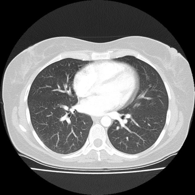 Bronchial atresia (Radiopaedia 22965-22992 Axial lung window 23).jpg