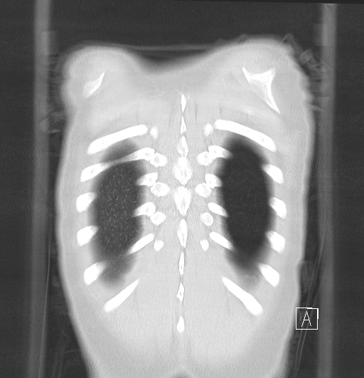 File:Bronchial atresia (Radiopaedia 73677-84470 Coronal lung window 33).jpg
