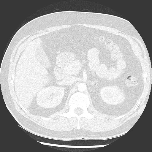 Bronchial carcinoid tumor (Radiopaedia 67377-76764 Axial lung window 68).jpg
