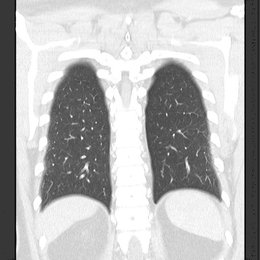 Bronchial carcinoid tumor (Radiopaedia 67377-76764 Coronal lung window 51).jpg