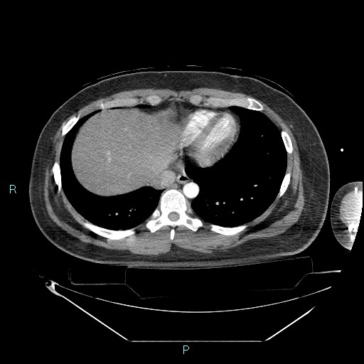 File:Bronchial carcinoid tumor (Radiopaedia 78272-90870 B 92).jpg