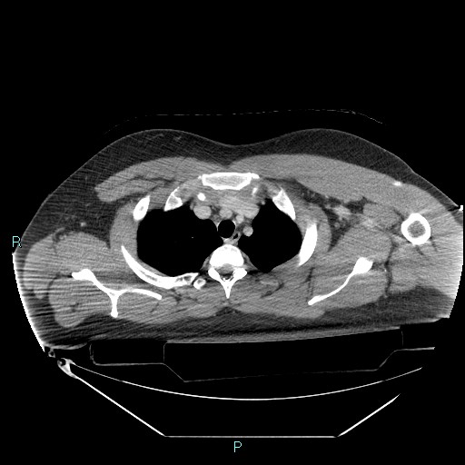Bronchial carcinoid tumor (Radiopaedia 78272-90870 C 28).jpg