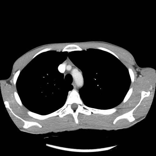 Bronchial carcinoid tumor causing right lower lobe collapse (Radiopaedia 83495-98594 A 11).jpg
