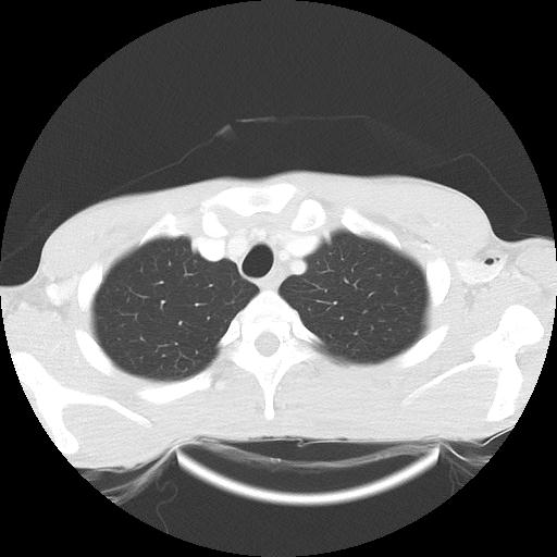 Bronchial carcinoid tumor causing right lower lobe collapse (Radiopaedia 83495-98594 Axial lung window 5).jpg