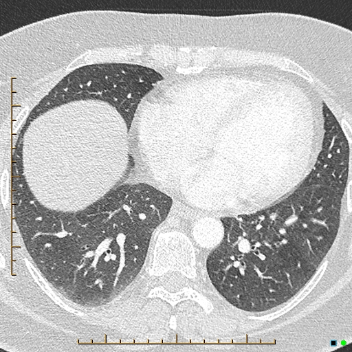 File:Bronchial diverticula (Radiopaedia 79512-92676 Axial lung window 140).jpg