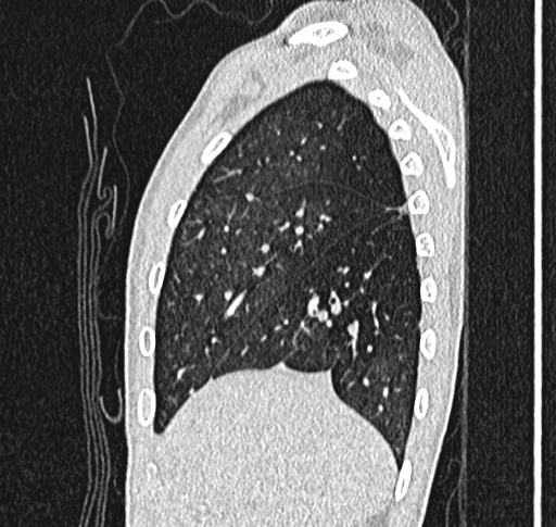 Bronchiolitis obliterans (Radiopaedia 71538-81897 Sagittal lung window 12).jpg
