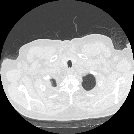 Bronchogenic carcinoma with metastatic lymphadenopathy (Radiopaedia 37671-39569 Axial lung window 6).jpg