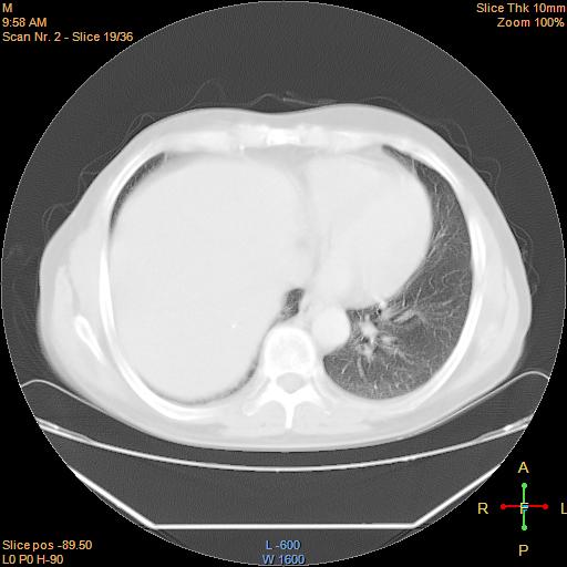 File:Bronchogenic carcinoma with superior vena caval invasion (Radiopaedia 22378-22406 lung window 16).jpg