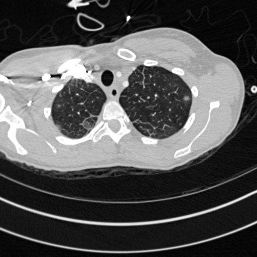 Bronchogenic cyst (Radiopaedia 77801-90071 Axial lung window 1).jpg