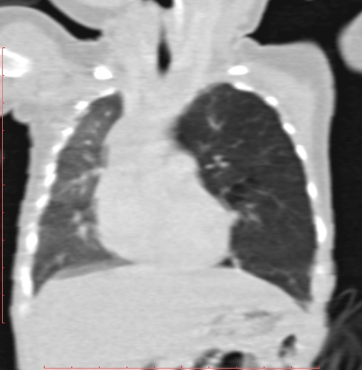 File:Bronchogenic cyst (Radiopaedia 78599-91409 Coronal lung window 94).jpg