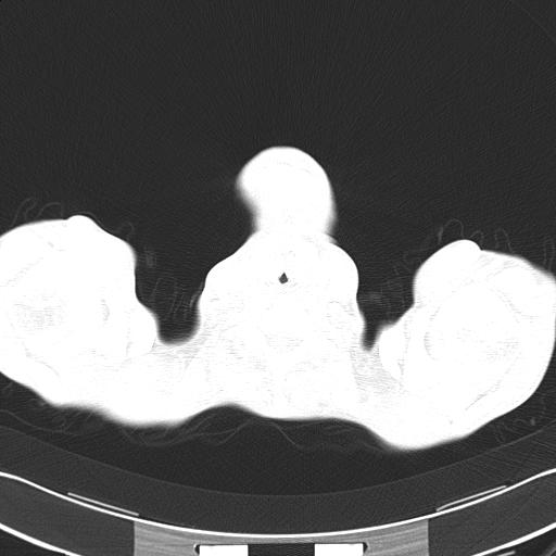 Bronchopleural fistula secondary to tuberculosis (Radiopaedia 20415-20322 Axial lung window 1).jpg