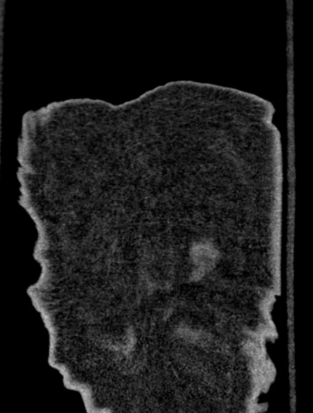Bronchus suis (Radiopaedia 39631-41953 Coronal non-contrast 131).jpg