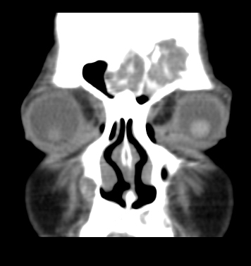 File:Brown tumors (Radiopaedia 9666-10291 Coronal non-contrast 1).jpg