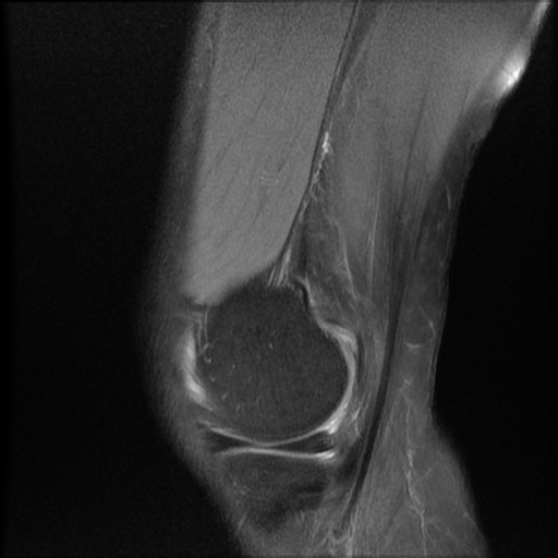 File:Bucket-handle meniscus tear (Radiopaedia 65700-74809 Sagittal PD fat sat 5).jpg
