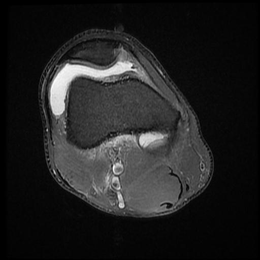 File:Bucket handle tear - medial meniscus (Radiopaedia 69245-79026 Axial PD fat sat 4).jpg