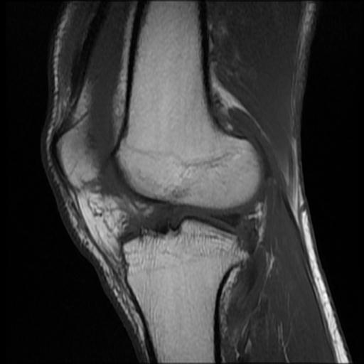 File:Bucket handle tear - medial meniscus (Radiopaedia 69245-79026 Sagittal T1 7).jpg