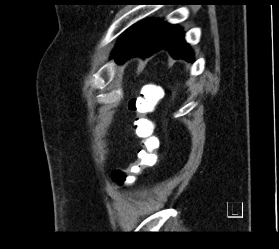Buried bumper syndrome - gastrostomy tube (Radiopaedia 63843-72577 Sagittal Inject 10).jpg