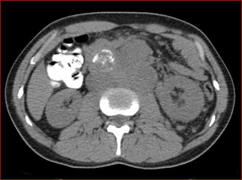 File:Burned-out testicular choriocarcinoma (Radiopaedia 32822-34040 Axial non-contrast 10).jpg