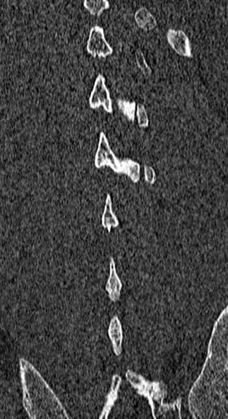 Burst fracture (Radiopaedia 53373-59357 Coronal bone window 69).jpg