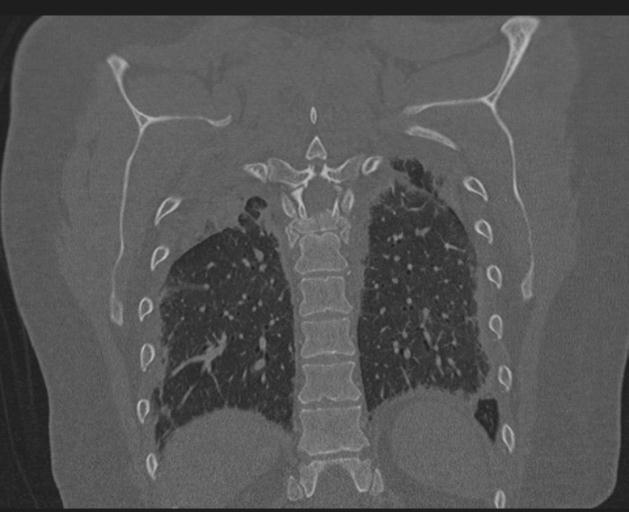 Burst fracture - thoracic spine (Radiopaedia 30238-30865 Coronal bone window 127).jpg