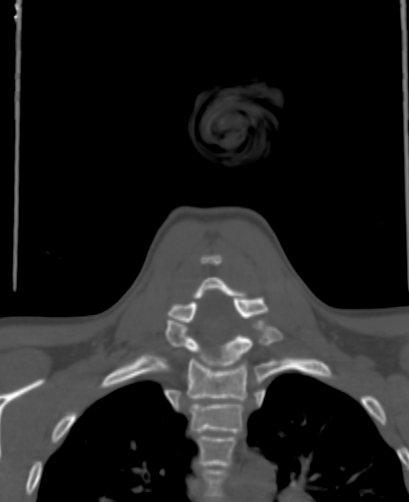 Butterfly vertebra (Radiopaedia 77903-90209 Coronal bone window 56).jpg