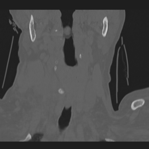 File:C2 fracture (Radiopaedia 34091-35341 Coronal bone window 7).png