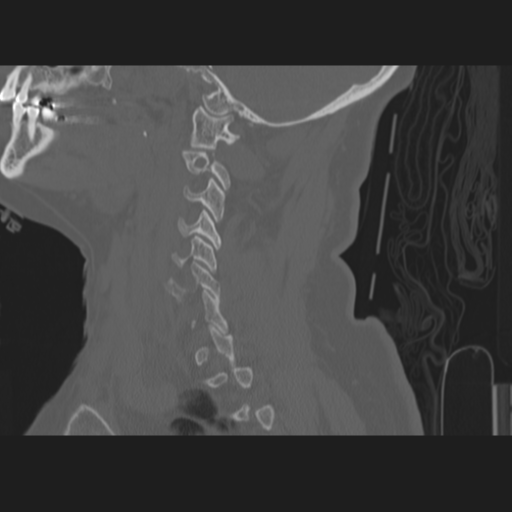 C2 fracture (Radiopaedia 34091-35341 Sagittal bone window 51).png