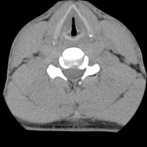 C5 facet fracture (Radiopaedia 58374-65499 Axial non-contrast 58).jpg