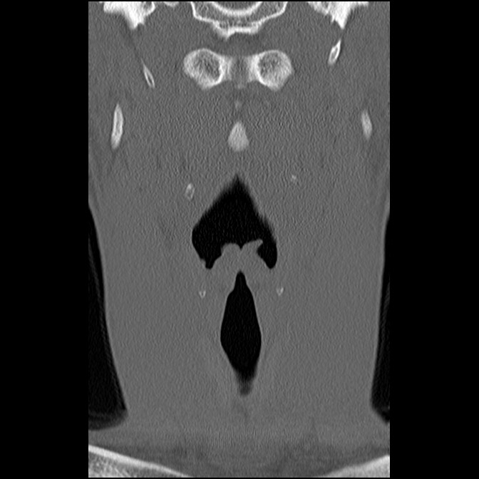 C5 facet fracture (Radiopaedia 58374-65499 Coronal bone window 16).jpg