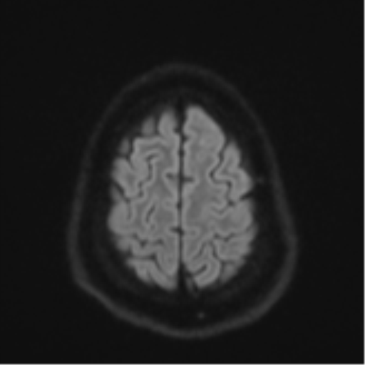 File:CNS vasculitis (Radiopaedia 55715-62263 Axial DWI 55).png