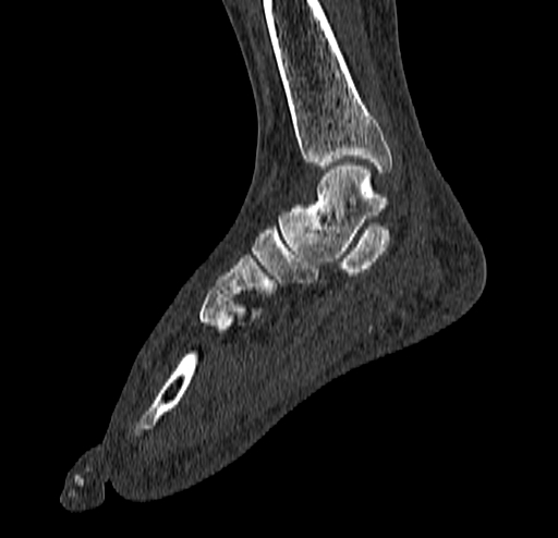 Calcaneal fracture - Sanders type 4 (Radiopaedia 90179-107370 Sagittal bone window 42).jpg