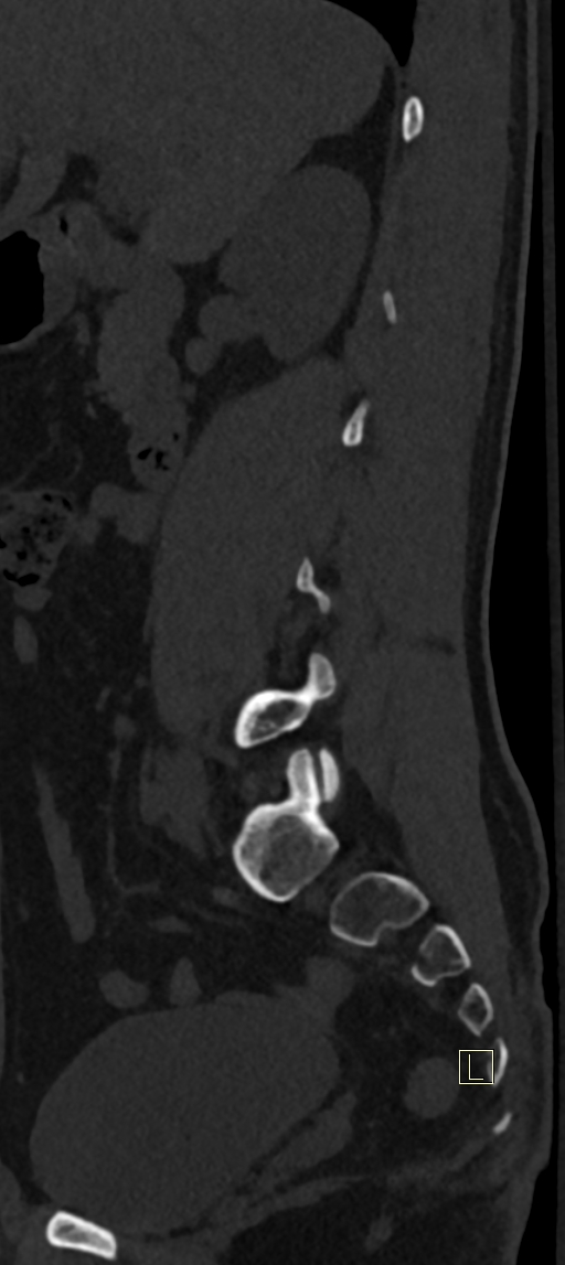 Calcaneal fractures with associated L2 burst fracture (Radiopaedia 71671-82493 Sagittal bone window 63).jpg