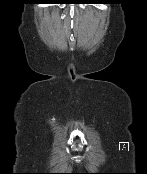 Calcified adrenal glands and Spigelian hernia (Radiopaedia 49741-54988 B 113).jpg