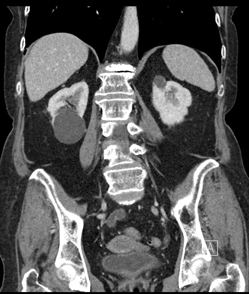 Calcified adrenal glands and Spigelian hernia (Radiopaedia 49741-54988 B 76).jpg