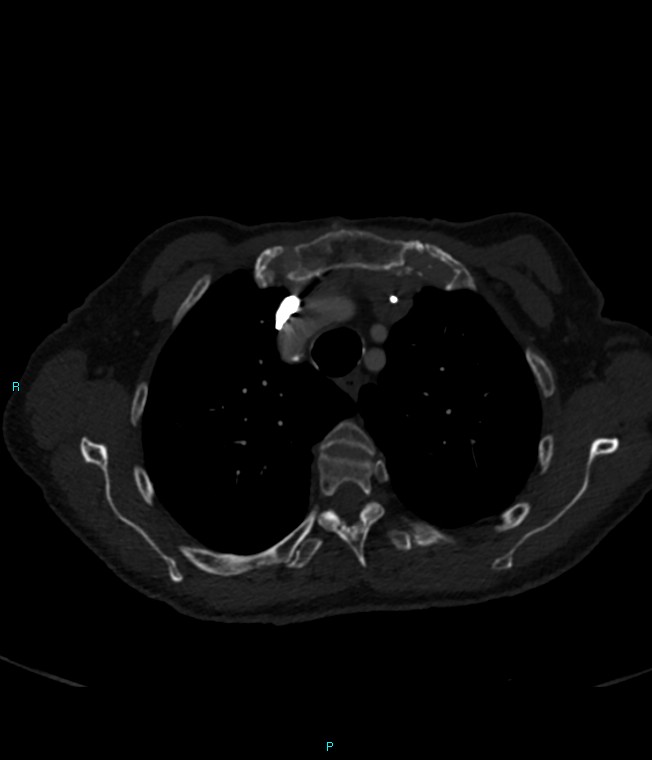 Calcified cerebral emboli from left ventricular thrombus (Radiopaedia 84420-99760 Axial bone window 17).jpg