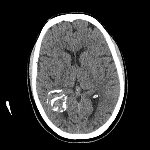 Calcified cerebral hydatid cyst (Radiopaedia 65603-74717 Axial non-contrast 37).jpg