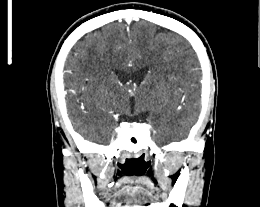 Calcified cerebral hydatid cyst (Radiopaedia 65603-74717 C 31).jpg