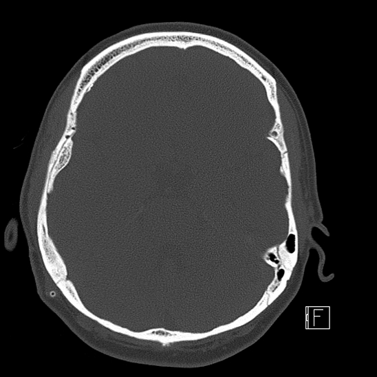 Calcified chronic subdural hematoma (Radiopaedia 77374-89492 Axial bone window 45).jpg