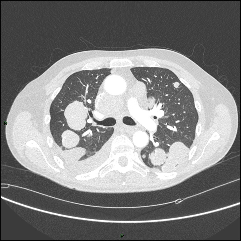 Cannonball metastases (Radiopaedia 82110-96150 Axial lung window 84).jpg