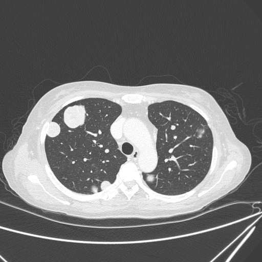 File:Canonball lung metastasis (Radiopaedia 77634-89837 Axial lung window 57).jpg