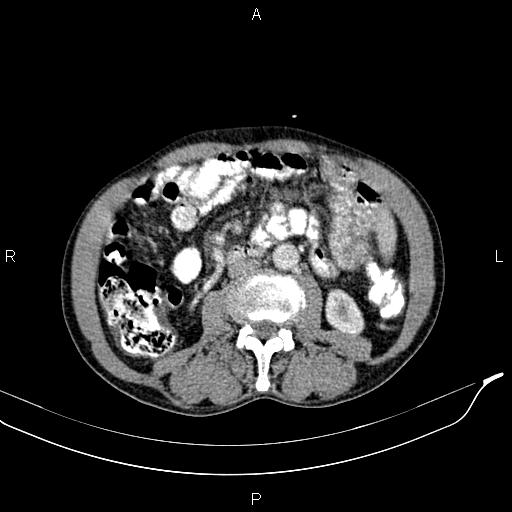 Caput medusae sign - portal hypertension (Radiopaedia 64007-72759 A 48).jpg