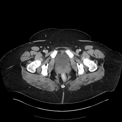 File:Carcinoid tumor - terminal ileum (Radiopaedia 60931-68739 A 135).jpg