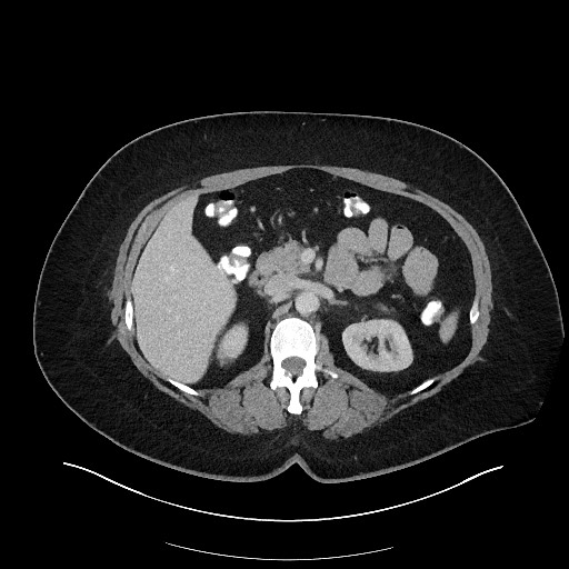 Carcinoid tumor - terminal ileum (Radiopaedia 60931-68739 A 47).jpg