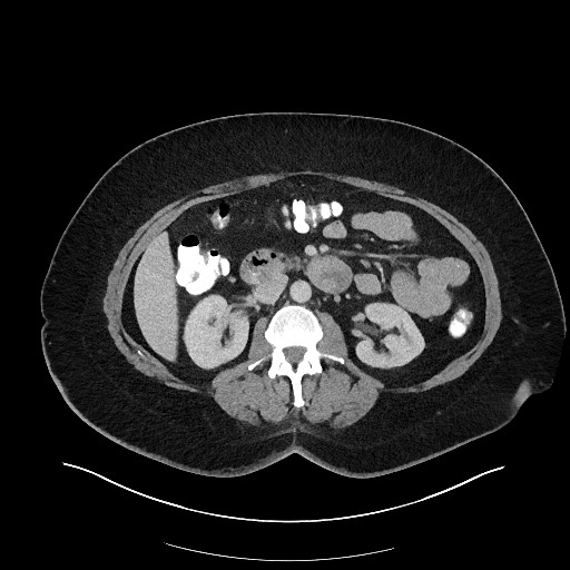 Carcinoid tumor - terminal ileum (Radiopaedia 60931-68739 A 57).jpg