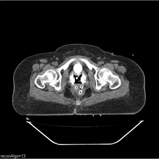 File:Carcinoma cervix- brachytherapy applicator (Radiopaedia 33135-34173 Axial non-contrast 38).jpg