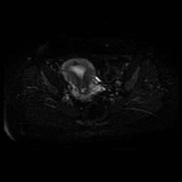Carcinoma of the cervix (Radiopaedia 89018-105858 Axial DWI 16).jpg