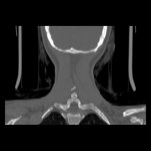 Carcinoma of the maxillary antrum (Radiopaedia 53805-59888 Coronal bone window 134).jpg